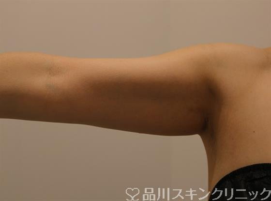 症例NO.44754のBEFORE写真