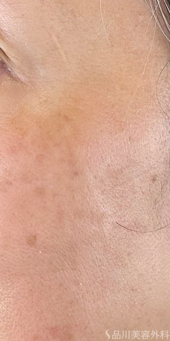 症例NO.72414のAFTER写真