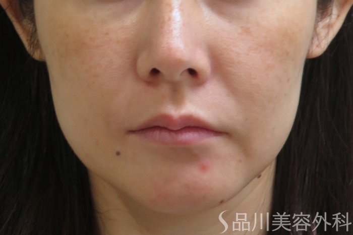 症例NO.73828のBEFORE写真
