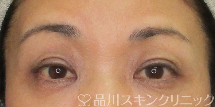 症例NO.69692のAFTER写真