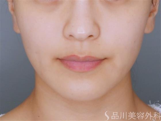 症例NO.51267のBEFORE写真