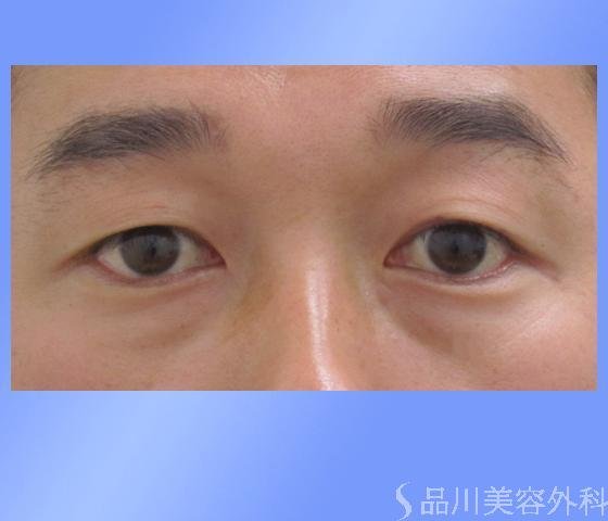 症例NO.2474のBEFORE写真