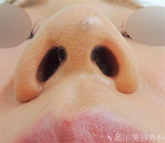 症例NO.24109のAFTER写真