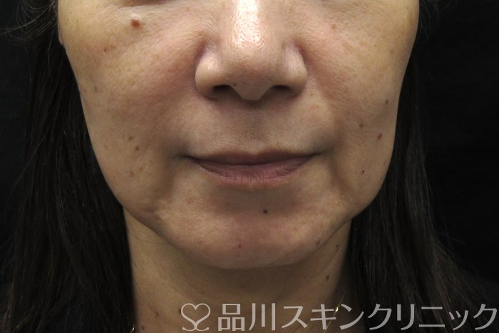 症例NO.74763のBEFORE写真
