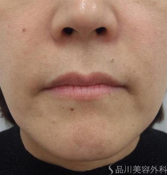 症例NO.10573のBEFORE写真