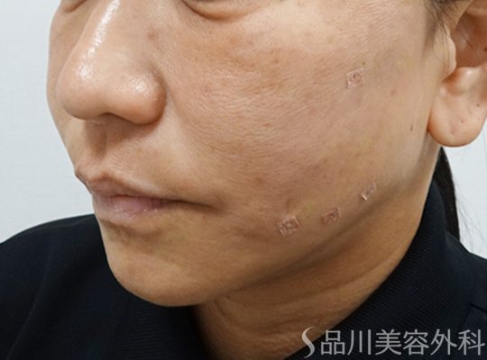 症例NO.72847のAFTER写真