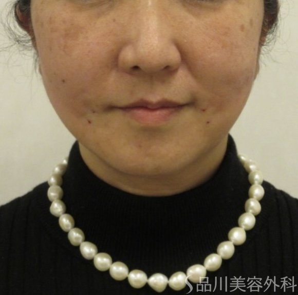 症例NO.72548のAFTER写真