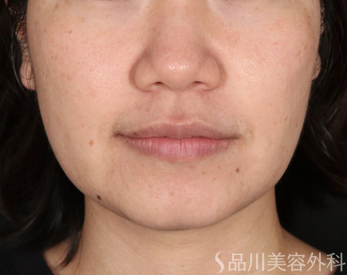 症例NO.73715のBEFORE写真