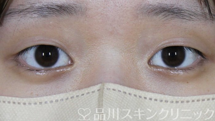 症例NO.72013のBEFORE写真