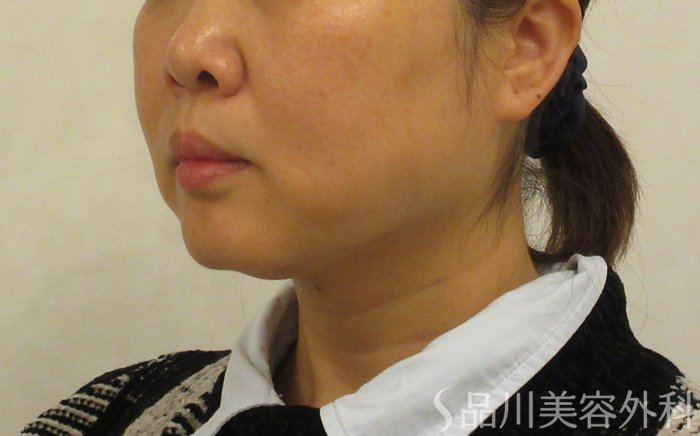 症例NO.72202のBEFORE写真