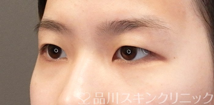 症例NO.65026のBEFORE写真