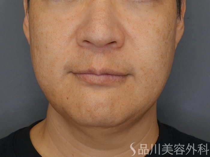 症例NO.73068のAFTER写真