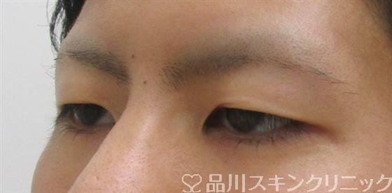 症例NO.42339のBEFORE写真
