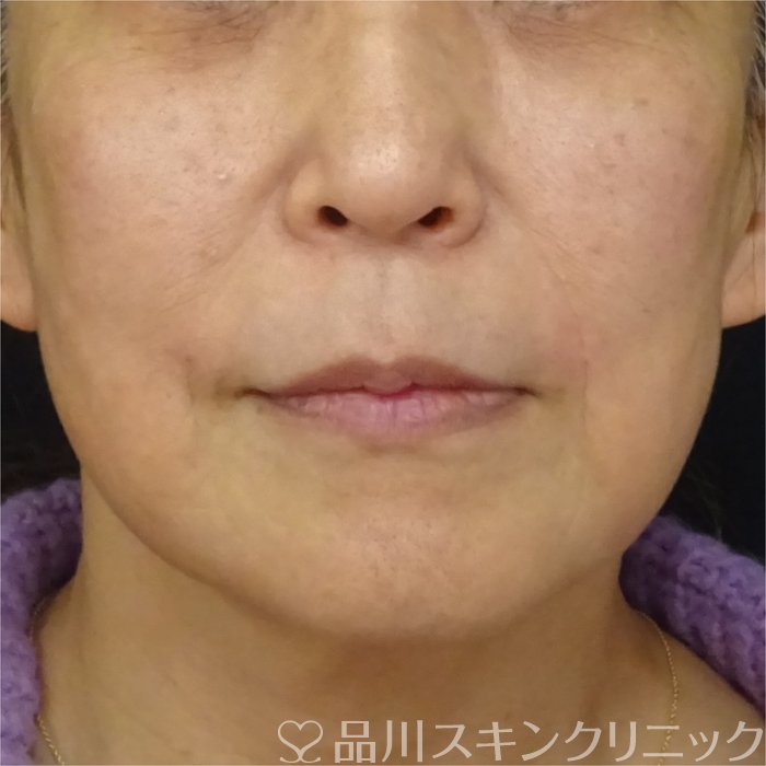 症例NO.69322のAFTER写真
