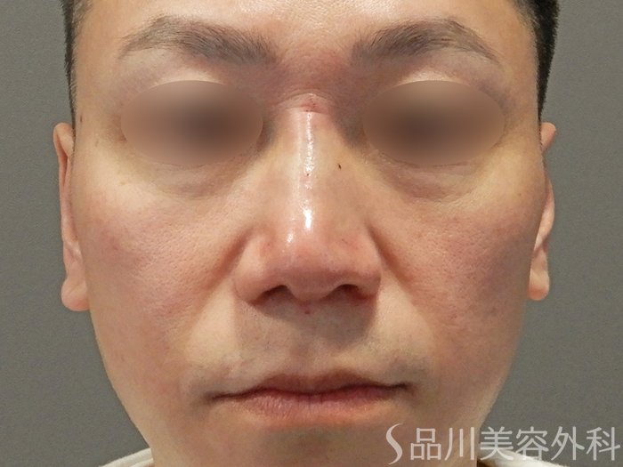 症例NO.70476のAFTER写真