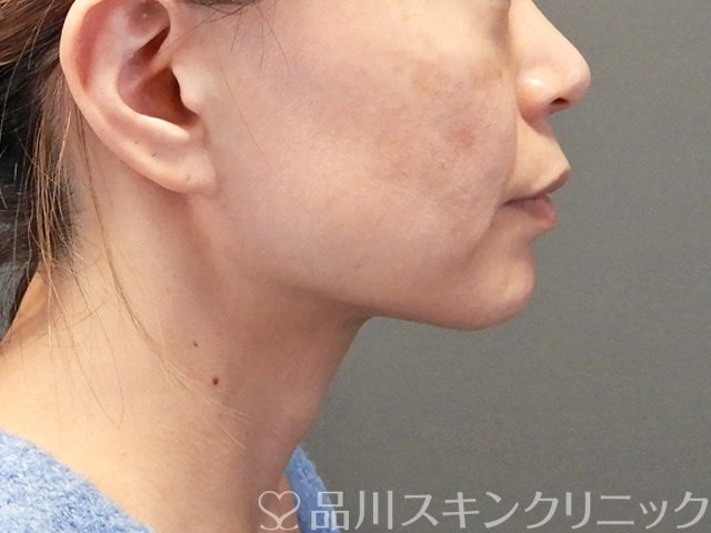 症例NO.63835のBEFORE写真