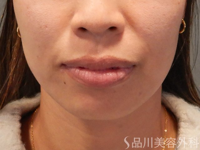 症例NO.72332のBEFORE写真