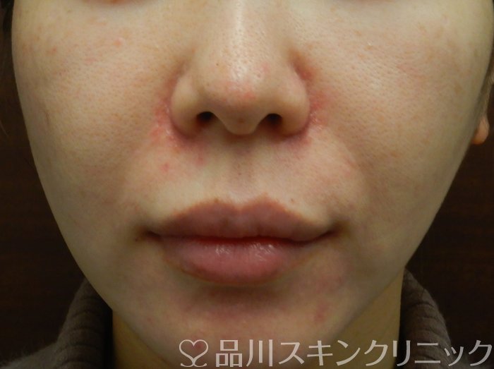 症例NO.66481のBEFORE写真