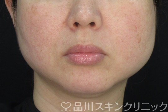 症例NO.72676のBEFORE写真