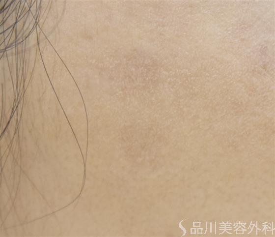 症例NO.53104のAFTER写真