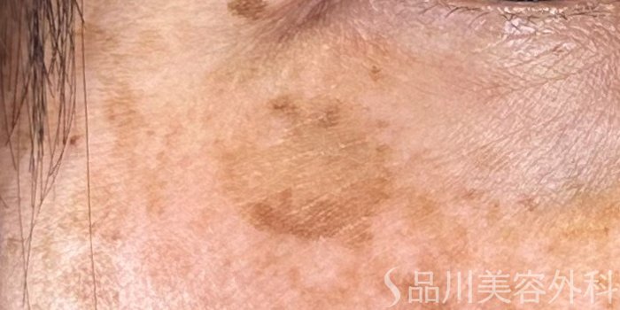 症例NO.70662のBEFORE写真