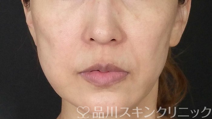 症例NO.71287のBEFORE写真