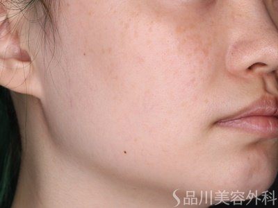 症例NO.73574のBEFORE写真