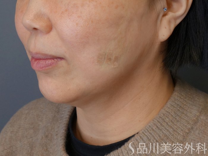 症例NO.72667のAFTER写真