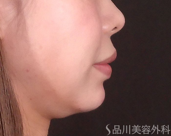 症例NO.70134のAFTER写真