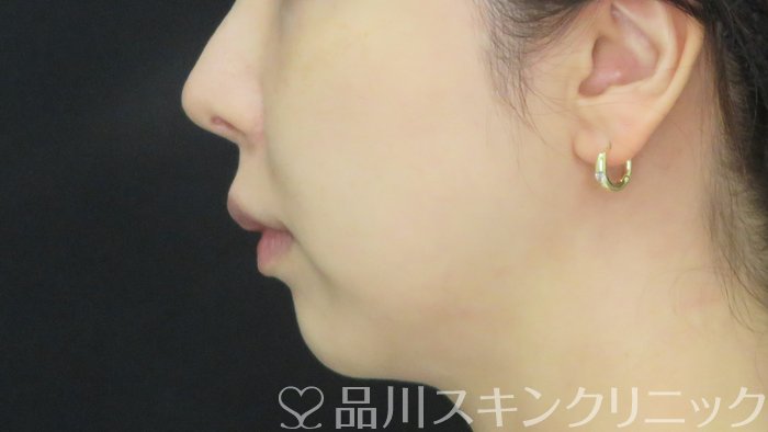 症例NO.71769のBEFORE写真