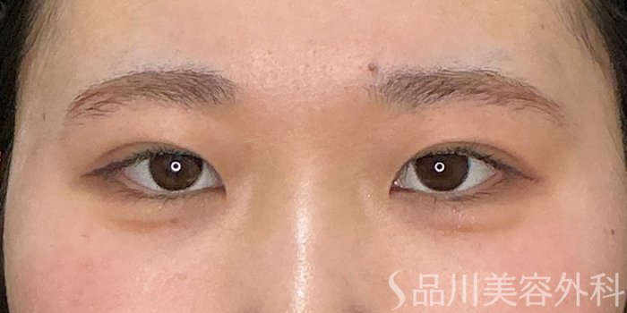 症例NO.73242のAFTER写真