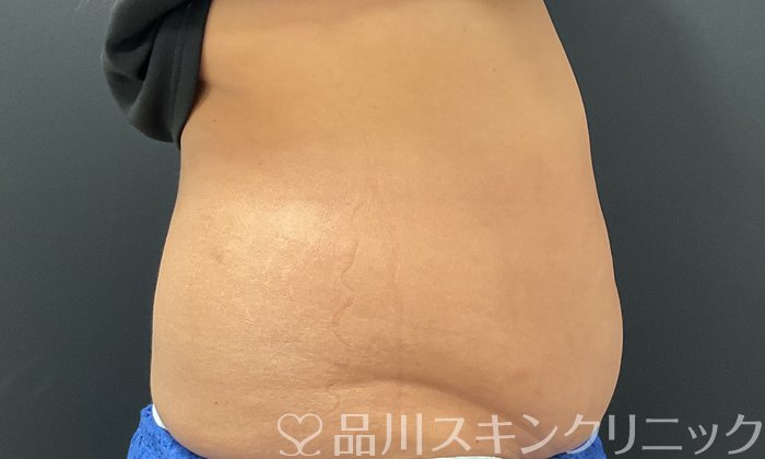 症例NO.74641のBEFORE写真
