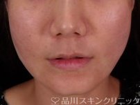 症例NO.71655のAFTER写真