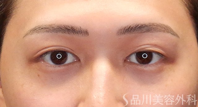 症例NO.74985のBEFORE写真