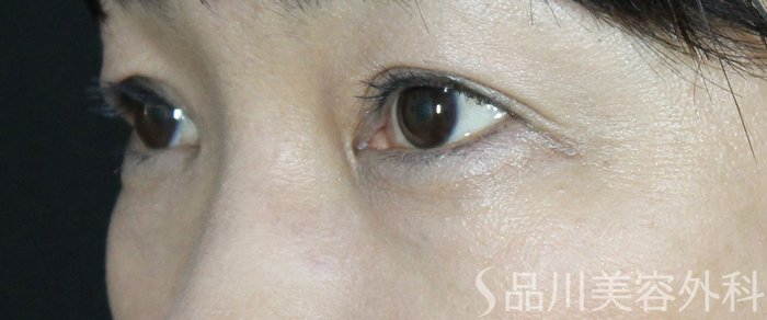 症例NO.72301のAFTER写真