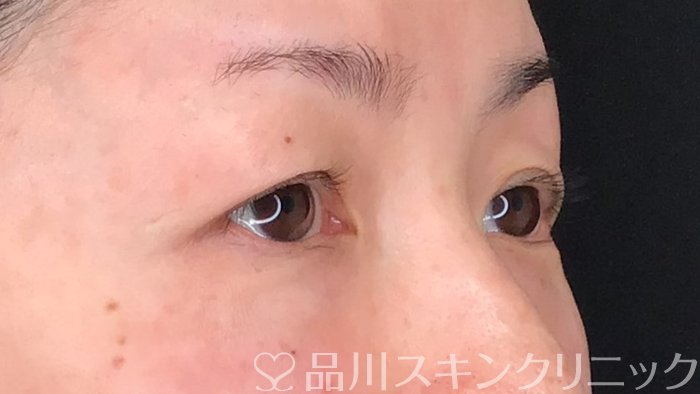 症例NO.64479のBEFORE写真
