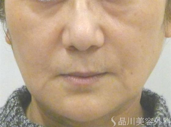 症例NO.40813のBEFORE写真