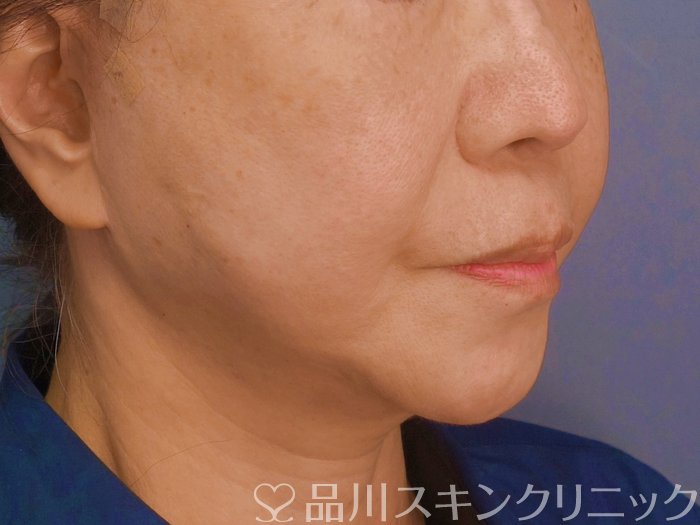 症例NO.74696のAFTER写真