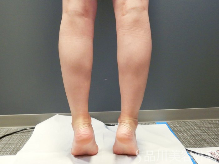 症例NO.64828のBEFORE写真