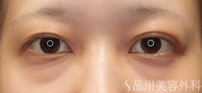 症例NO.71450のBEFORE写真