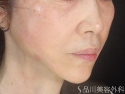 症例NO.73849のAFTER写真