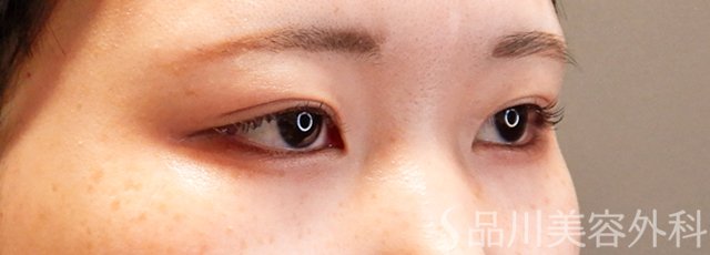 症例NO.68675のAFTER写真