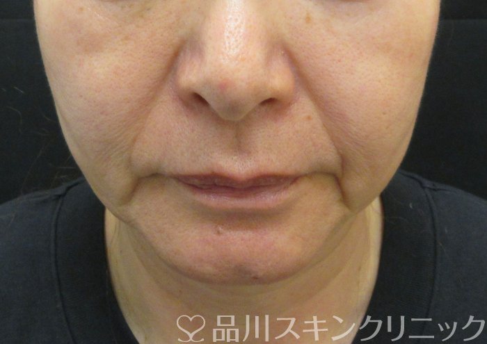 症例NO.73936のBEFORE写真