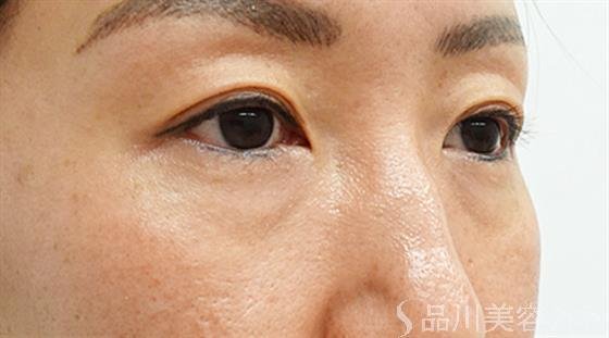 症例NO.44609のBEFORE写真