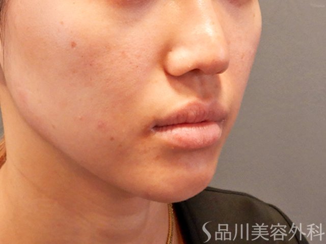 症例NO.70029のBEFORE写真
