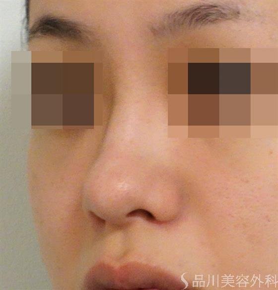 症例NO.42764のBEFORE写真