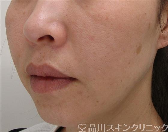 症例NO.53322のAFTER写真