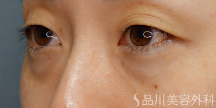 症例NO.70369のBEFORE写真