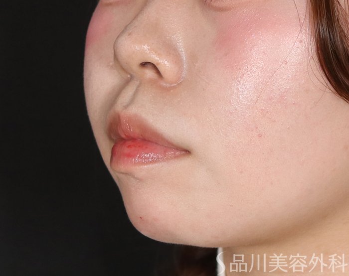 症例NO.72783のAFTER写真