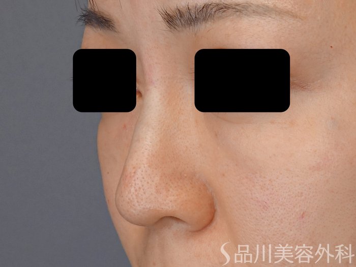 症例NO.72466のAFTER写真